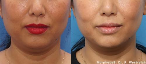 Morpheus8_BeforeAfter (13)