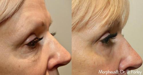Morpheus8_BeforeAfter (14)