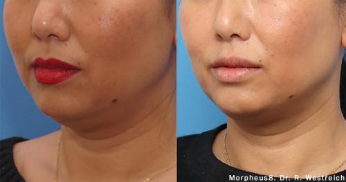 Morpheus8_BeforeAfter (16)
