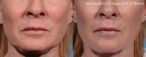 Morpheus8_BeforeAfter (17)