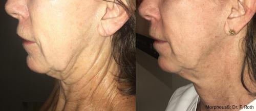 Morpheus8_BeforeAfter (18)