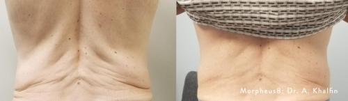Morpheus8_BeforeAfter (19)