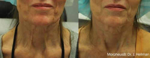 Morpheus8_BeforeAfter (7)