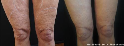Morpheus8_BeforeAfter (8)
