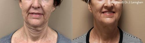 Morpheus8_BeforeAfter (9)