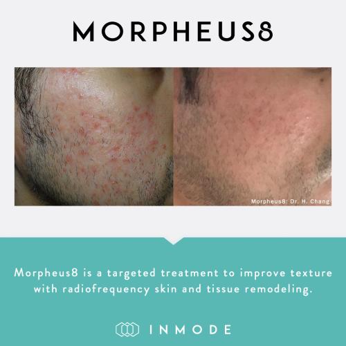 Morpheus8_BeforeAndAfter_SocialPost (2)