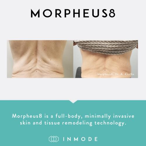 Morpheus8_BeforeAndAfter_SocialPost (3)